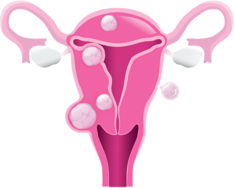 Different types of uterine fibroids.